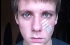 Irish guy makes remarkable timelapse video of his face healing after plastic surgery