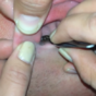 Friends pull huge moth out of man's ear with tweezers