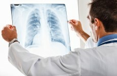 Lung cancer deaths have increased in Ireland