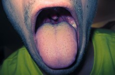 Guinness record set for world’s largest… tonsils