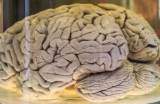 100 human brains have gone missing from a university in Texas
