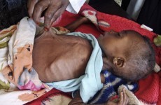 UN declares famine in parts of Somalia