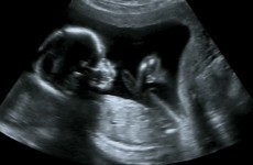 baby measuring small at 8 weeks no heartbeat