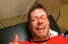 Nobody loves getting hit in the face quite like Bakkies Botha