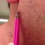 This guy's incredibly long ingrowing hair will gross you out like nothing else