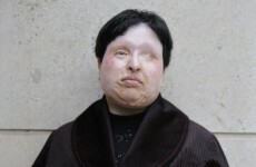 Iranian man due to be blinded over acid attack pardoned by victim