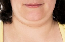 A new injection could 'cure' double chins