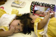 Formerly conjoined twins celebrate milestone 10th birthday