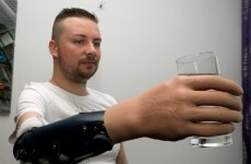Three men chose to have their arms "amputated" to get robotic replacements