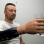 Three men chose to have their arms "amputated" to get robotic replacements