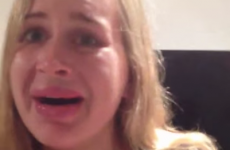 Woman's attempt at getting Kylie Jenner lips goes spectacularly wrong