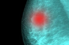 This test means no chemotherapy for some breast cancer patients