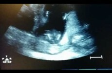 Everyone is baffled by this ultrasound of a baby clapping in the womb