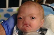 Little Eli, who was born without a nose, is capturing hearts across the world