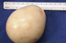 Doctors found this half-pound "egg" inside a man