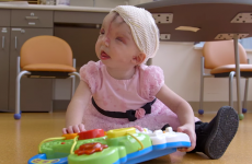 Surgeons are using 3D printers to reshape this girl's face
