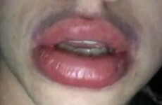 Teenagers are doing the 'Kylie Jenner lip challenge' and it's legit horrifying