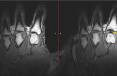 This is why knuckles make a noise when they crack