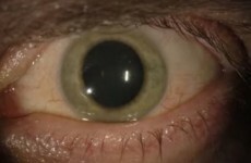 US man told he was free from Ebola - but then his blue eye turned green...