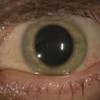 US man told he was free from Ebola - but then his blue eye turned green...