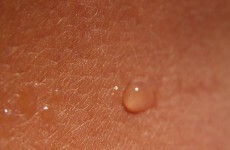 New method of monitoring skin could replace biopsies: UL study