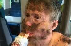 This man's mates glued their pubic hair to his face for a stag party