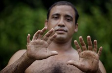 Here's the Cuban man with two extra fingers and two extra toes