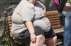 Weight-loss surgery is good for the economy - surgeons
