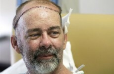 This man has just had the world's first skull transplant