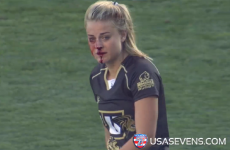 This rugby player played on despite a broken nose and captured the internet's heart