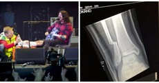 Dave Grohl fell off the stage last night, broke his leg, kept performing