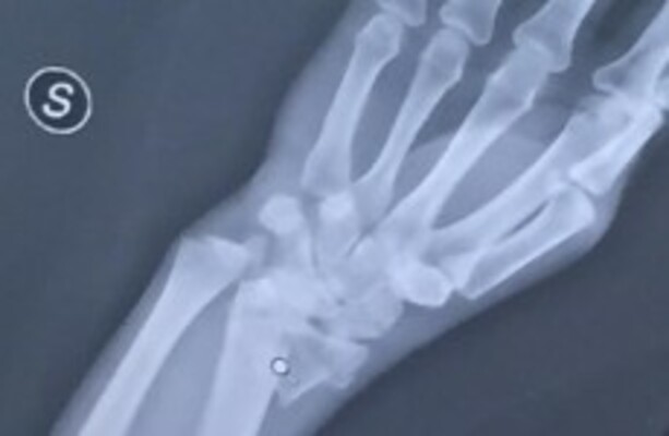 Olympic champion feared her hand would be amputated following 'bone ...