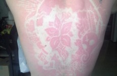 People are getting sunburned on purpose for 'sunburn tattoos'
