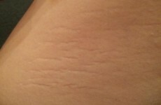 Women are celebrating their stretch marks with the inspiring #ThighReading hashtag