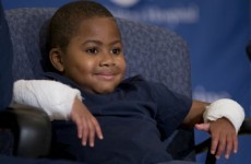 8-year-old who lost his limbs to infection gets a double hand transplant