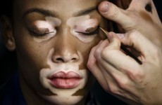 Is copying this model's skin condition racist?