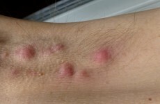 Hundreds of people could have an excruciating skin disease but be too embarrassed to get diagnosed