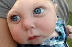Miracle baby born with malformed brain has reached his first birthday