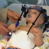 Toddler's head reattached after internal decapitation