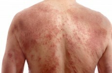 'Living with psoriasis isn't easy. I never wear dark clothes and short sleeves are just not an option'