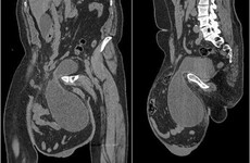 Man has football-sized hernia removed from his scrotum after 12 years