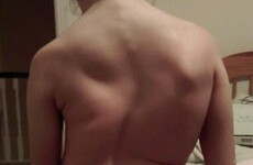 This is the curved spine of a teenager whose surgery was cancelled yesterday