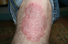 Suffer with psoriasis? They may be about to completely change how it's treated