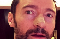 Hugh Jackman tells people to wear sunscreen after another skin cancer surgery