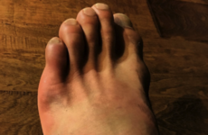 Here's the injury that forced Rafael dos Anjos out of UFC 196