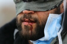 Calais migrants sew lips shut in protest against destruction of camp