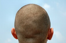 Man accused of shaving head and taking weight loss pills to fake cancer