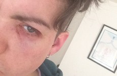 Dublin woman punched four times in the face in homophobic attack after night out