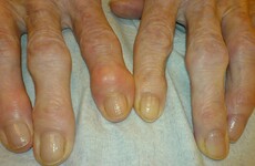 One of the most common treatments for osteoarthritis is 'ineffective'