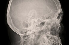 Public patients waiting 20 times as long for brain scans than private patients